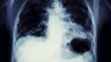 Claiming asbestos disease compensation for the death of a family member